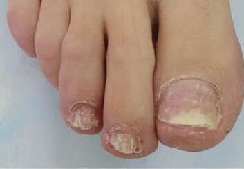 Mycosis of the nails caused trouble