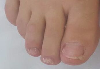 Promicil cures advanced onychomycosis