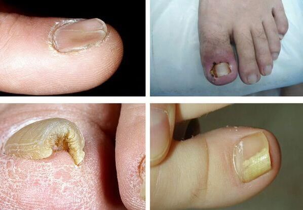 what does nail fungus look like