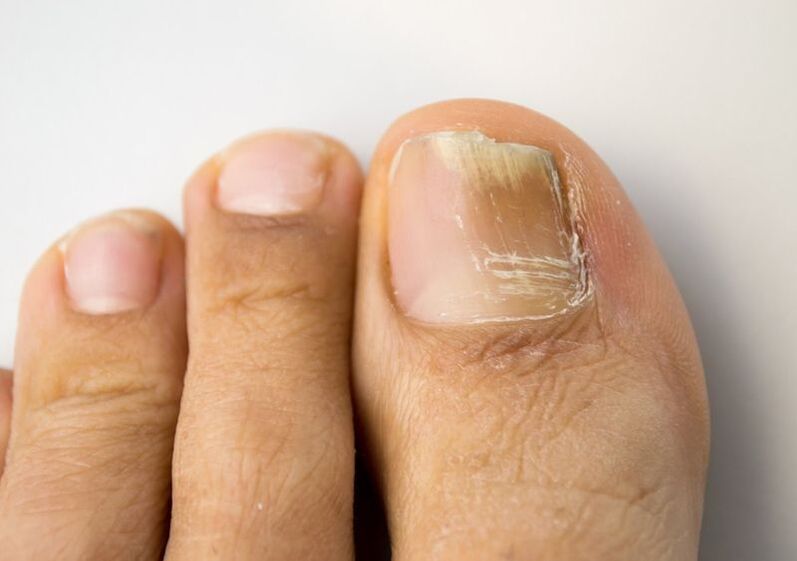 fungus on the nails of the big toe