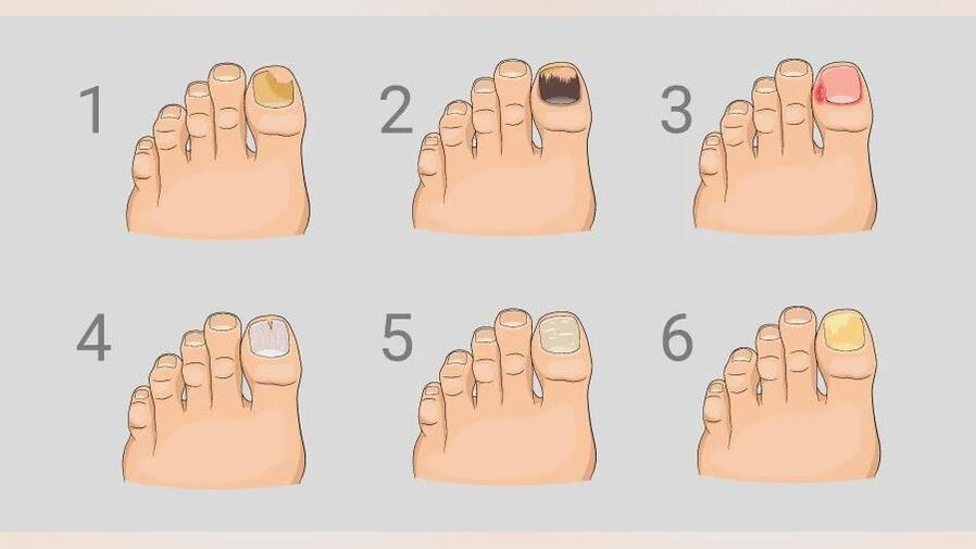 The main signs of foot fungus