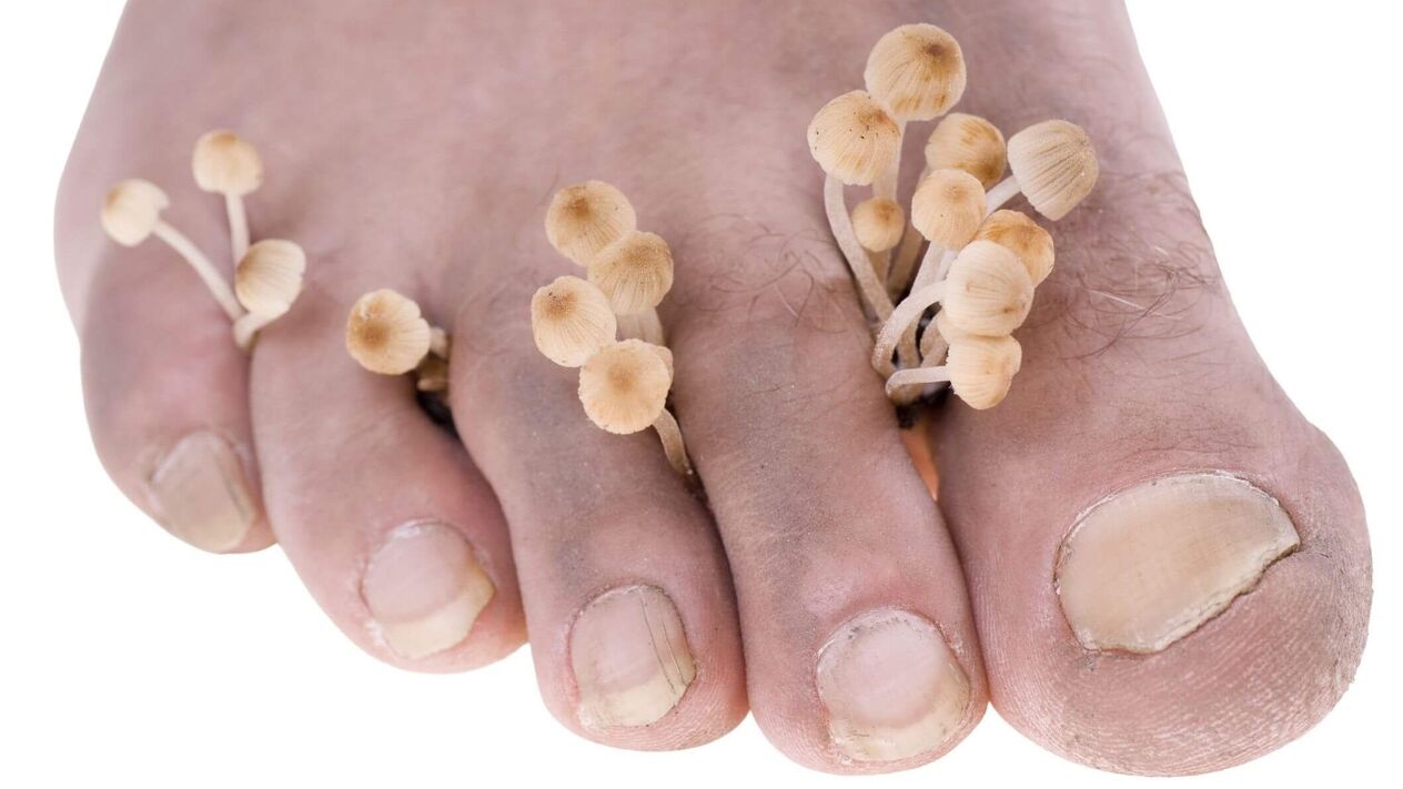 fungal infection of human feet