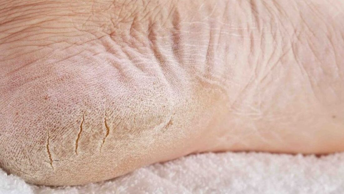 fungal infection of the feet