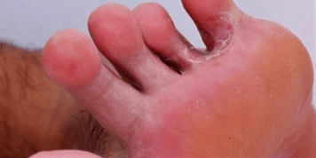 The fungus of the feet