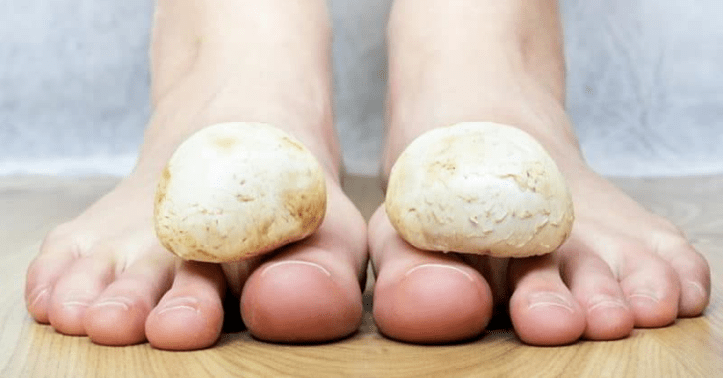 Fast treatment of fungi on the feet at home