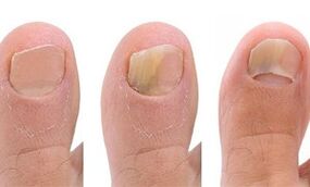Stages of development of the fungus of the thumb