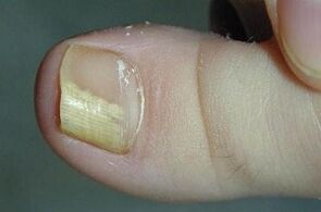 The causes of the fungus of the thumb