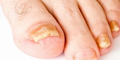 How and how to cure nail fungus