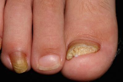 Mycosis of the toenails