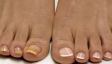 The reasons for the appearance of nail fungus