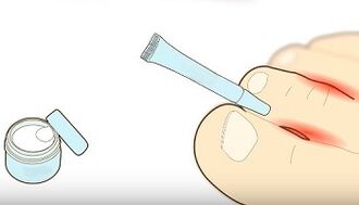 How to treat fungus on the toes
