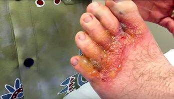 Symptoms of fungi on the toes