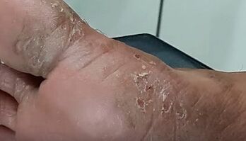 Types and shapes of fungi on the toes