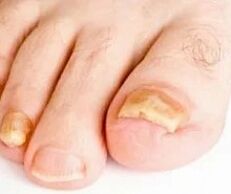 Onychomycosis
