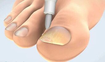 collection of scrapings from onychomycosis