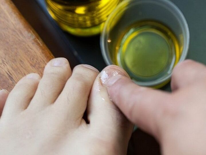 Applying medicated oil to nails affected by fungus