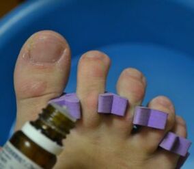 Preparation for nail treatment with anti-fungal drops