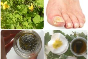 folk remedies for the treatment of nail fungus